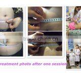 Non-surgical Treatment Slimming Liposonix Body Shaping Machine thumbnail-6