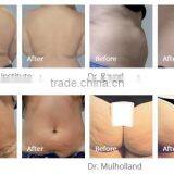 RF Body Contouring / Anti-cellulite Machine / Vacuum+RF+Infrared+Roller thumbnail-2