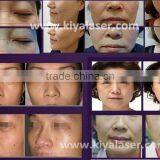 Distributor Price Hifu for Skin Tightening thumbnail-4
