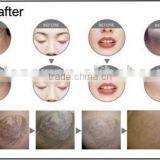 nd Yag Laser With Black Tip for Skin Whitening Laser Carbon Treatment thumbnail-4
