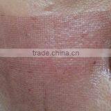 Vascular Treatment Fractional CO2 Laser Equipment Pigment Removal Redness Removal 10600nm CO2 Laser Device Acne Treatment Skin Regeneration thumbnail-6