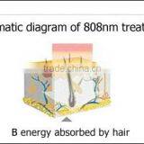 CE Approved Best-selling Diode Laser Gold Standard Hair Removal With 10 BARS thumbnail-5