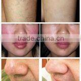 Spider Vascular Vein Removal Machine 980nm Diode Laser Varicose Veins Machine thumbnail-6