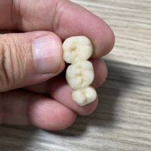 Metal Acrylic Dental Crown China Dental Laboratory thumbnail-4