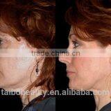 2016most Popular Fractional rf Micro Needle/fractional rf Skin Rejuvenation Device/rf Micro Needle Facelift Machine thumbnail-6