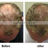 2016 Raynol Laser Hair Growth Equipment thumbnail-3