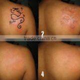 Telangiectasis Treatment Professional Active Q-Switch ND YAG Tattoo Removal Varicose Veins Treatment Laser Machine China And Tatoo Remove Laser thumbnail-1