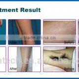CE ISO ROHS Approved Micro Channel Laser Bars Diode Laser Hair Removal Machine With Promotion Price thumbnail-4