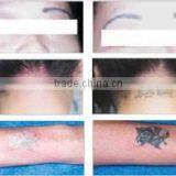 1 HZ 1600mj Strong Power Tattoo Removal Freckles Removal Q Switch Nd Yag Laser thumbnail-2