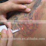 Most Effective Tattoo Removal Laser Equipment Removal Tattoo Laser thumbnail-3