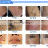 Popular Vertical IPL Laser Hair Removal Machine for Salon/clinic/personal Use thumbnail-6