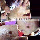 High Frequency Spot Removal Pen Speckle Removal thumbnail-2