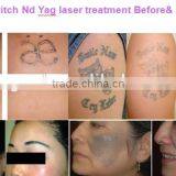 Big Spot Size Professional Medical Tattoo Removal Laser Equipment New Q-switch ND YAG Laser thumbnail-6