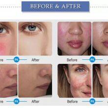 980nm Diode Laser Vascular Removal Machine and Spider Vein Treatment Machine thumbnail-4