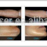 2014 Hot Seller !! Yuwei 808nm Hair Removal Beauty Machine With ce Approval thumbnail-5