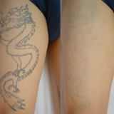 Q Switched Nd Yag Laser 1064nm&532nm Pigment Removal for Beauty Salon Use thumbnail-5