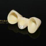 Dental Crown Zirconia PFZ, Dental Teeth, Dental Prosthesis, Laboratoire Dentaire, Dentallabor, Laboratorio Dental, Dental Laboratory, Shenzhen LJ Dental Lab China thumbnail-4