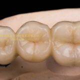 Dental Crown Zirconia Cercon,dental Teeth,dental Prosthesis Laboratoire Dentaire, Dentallabor, Laboratorio Dental, Dental Laboratory, Shenzhen LJ Dental Lab thumbnail-2