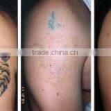 Hottest nd Yag Laser Treatment Medical Device for Birthmark Removal thumbnail-6
