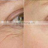 Low Price Radio Frequency rf Wrinkle Remover Machine for Sagging Skin Treatment and Pore Treatment thumbnail-6