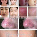 Hotsale Vein Stopper/ Vein Wave Machine/ Spider Vein Removal thumbnail-2