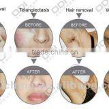 OD-A900 Beauty Machine for Skin Rejuvenation Fast Hair Removal Portable Ipl thumbnail-4