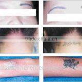 HOT Sell Sincoheren Nd:yag Laser Tattoo Removal Q-switch Skin Rejevenation. thumbnail-5