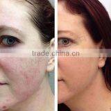 Warts Removal YUWEI---CO2 Fractional Cicatrice 10600nm Removal Laser Machine With Microneedle thumbnail-6