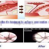 OEM/ODM Vaginal Tightening for Beauty Clinic Fractional Co2 Laser rf Tube thumbnail-3