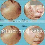 Saneh Co2 Fractional Laser Machine - Supercritical Face Lifting Co2 Extraction Machine For Vaginal Laxity Treatment Warts Removal thumbnail-6