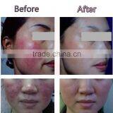 Portable High Frequency Blood Vessel Laser Therapy Machine thumbnail-6