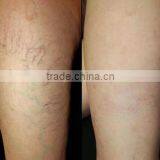 Professional Vascular Vein Stopper 980nm Varicose Veins Removal Diode Laser thumbnail-6