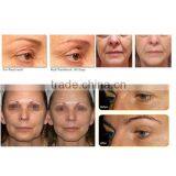 Portable High Frequency Face Machine Professional Face Lifting Machine Prices Hifu Fda Approval 0.1-2J thumbnail-5