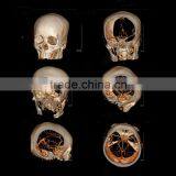 PET Medical Film for Laser Printing