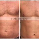 2016 Professional Portable SHR for Hair Removal and Skin Rejuvenation/ Hair Removal Electrolysis Machine/ Hair Remover With Puls thumbnail-6