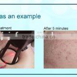 Portable Fractional CO2 Laser 30W F5 With ISO9001 thumbnail-6