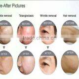 Protable Professional Micro Needle Wrinkle Removal Machine Fractional rf thumbnail-6