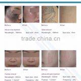 Q-switch 1000W Big Spot Nd Yag Laser for Tattoo Pigment Remaoval FDA Approved thumbnail-4