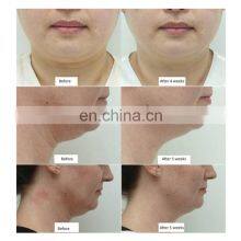 7 Cooling Paddles Body Shaping 360 Surrounding Fat Freezing Machine For Beauty Salon thumbnail-5