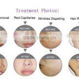 Portable Mini Home Laser Elight IPL Permanent Arms / Legs Hair Removal Hair Removal/IPL RF Facial Skin Rejuvenation Machine Skin Tightening thumbnail-2