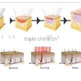 Hot Sale Portable Home-use RF 9D Thermacool Skin Resurfacing and RF Thermacool Effectively Machine thumbnail-3