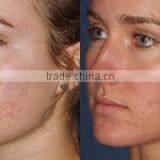 High Quality and Best Price Fractional C02 Laser Beauty Equipment Acne Treatment thumbnail-5