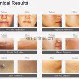 Buy Co2 Laser Choose High Quality GSD Refine Machine for Scar Repair,pigment Removal thumbnail-2