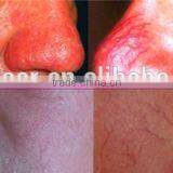 High Frequency Thermolysis Radio Frequency Spider Vein Removal Machine thumbnail-5