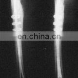 Bone Clasp With Rivet Teeth Ring Shaped TiNi SMA Fixater thumbnail-3