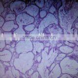 Adamantoblastoma Oral Pathology Prepared Slides/teaching Oral Pathology Slides/medical Oral Pathology Slides thumbnail-2