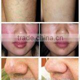 Best Treatment Result Spider Veins Laser Removal Machine EVLT Laser Red Blood Removal thumbnail-6