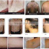 Hottest Germany Device 808 Diode / Personal Hair Removal Laser System thumbnail-4