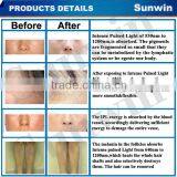 Medical CE Approval Pain Free Fast Hair Removal Elight With Factory Price thumbnail-2