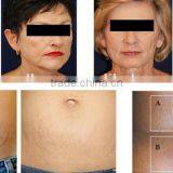 Professional Slimming Vacuum+auto-roller+ultrasonic Cavitation Radio Frequency Medical Device thumbnail-5